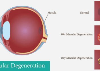 Overview of Macular Degeneration