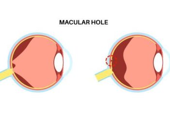 Overview of Macular Hole
