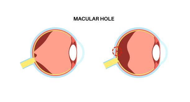 Overview of Macular Hole