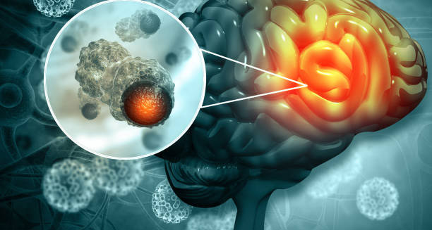 Overview of Malignant Brain Tumour