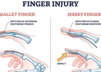 Overview of Mallet Finger