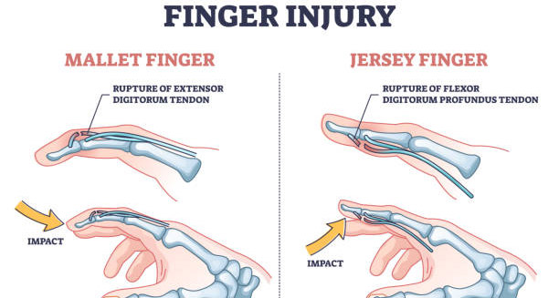 Overview of Mallet Finger