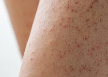 Close-up of skin with red bumps caused by keratosis pilaris on the thigh