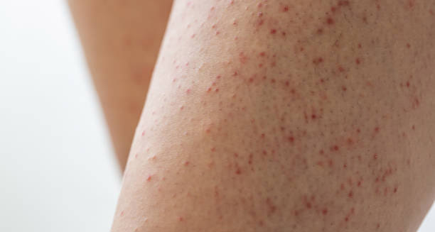 Close-up of skin with red bumps caused by keratosis pilaris on the thigh