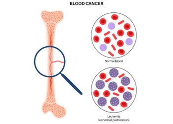Overview of Leukaemia