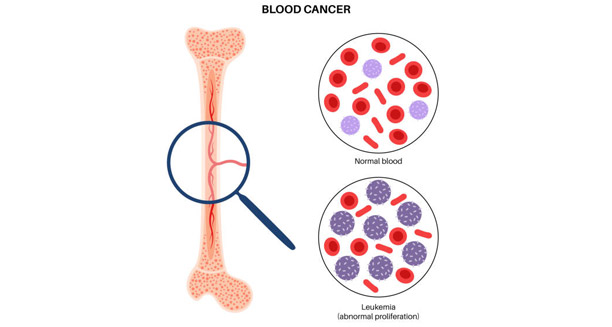 Overview of Leukaemia