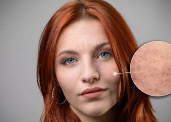 Close-up of a woman with visible symptoms of keratosis pilaris on her cheeks