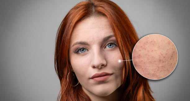 Close-up of a woman with visible symptoms of keratosis pilaris on her cheeks