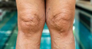 Symptoms of Knock Knees