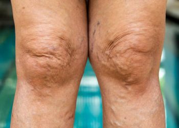 Symptoms of Knock Knees