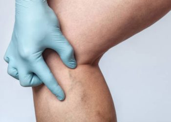 Symptoms of Leg Ulcer