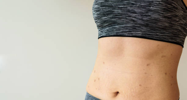 Symptoms of Lichen Planus