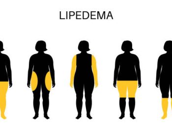 Symptoms of Lipoedema