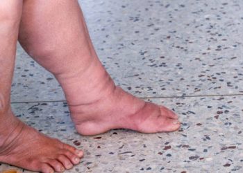 Symptoms of Lymphoedema