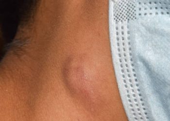 Symptoms of Lymphoma