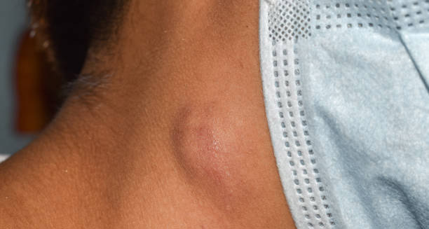 Symptoms of Lymphoma