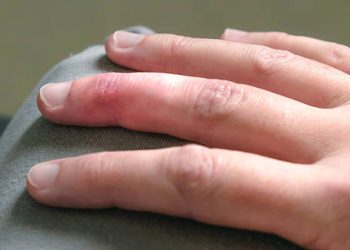 Symptoms of Mallet Finger