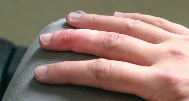 Symptoms of Mallet Finger