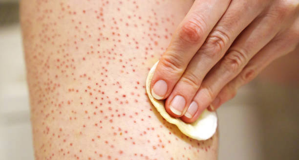 Applying exfoliating pad to treat keratosis pilaris on the skin