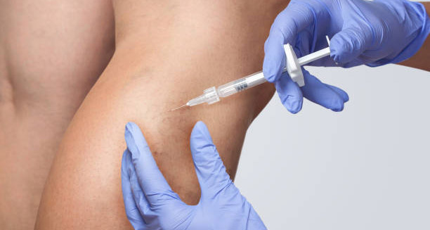 Treatment of Leg Ulcer