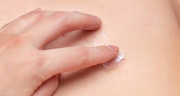 Treatment of Lichen Sclerosus