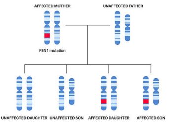 Causes of Marfan Syndrome