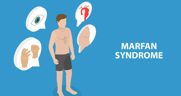 Complications of Marfan Syndrome