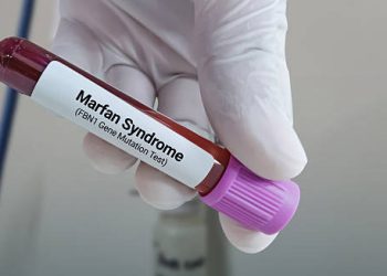 Diagnosis of Marfan Syndrome