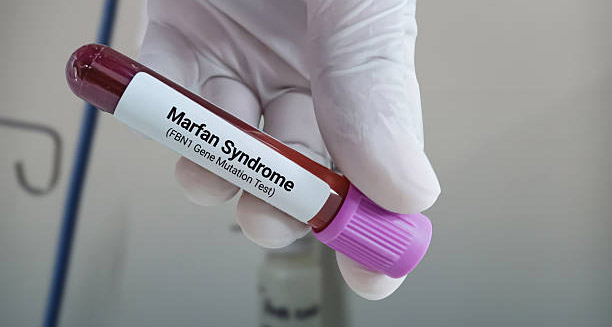 Diagnosis of Marfan Syndrome