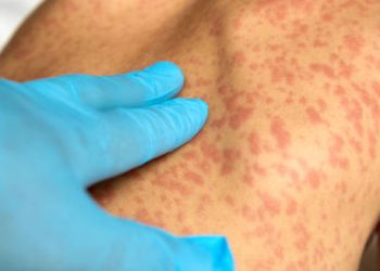 Diagnosis of Mastocytosis