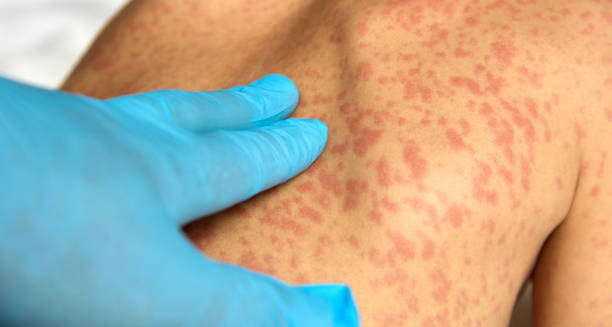 Diagnosis of Mastocytosis