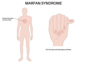 Marfan Syndrome