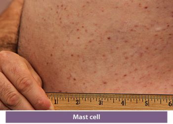 Overview of Mastocytosis