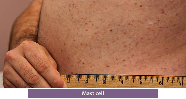 Overview of Mastocytosis