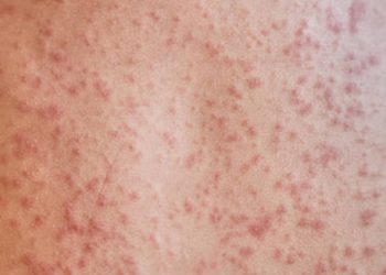 Symptoms of Mastocytosis