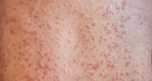 Symptoms of Mastocytosis