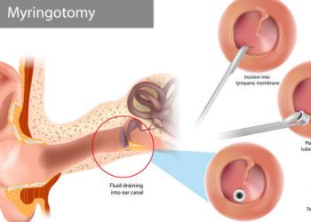 Treatment of Mastoiditis