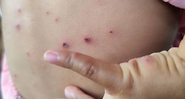 Complications of Measles