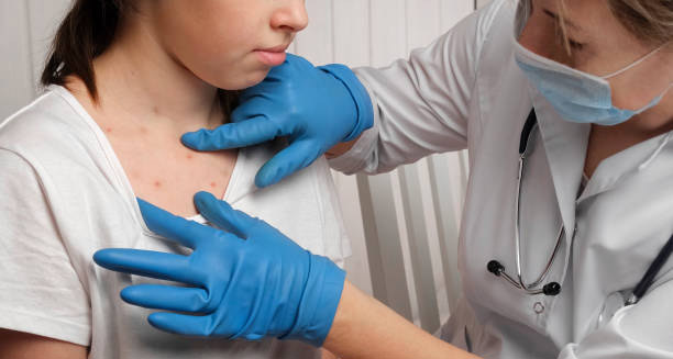 Diagnosis of Measles