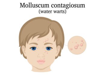 Diagnosis of Molluscum Contagiosum