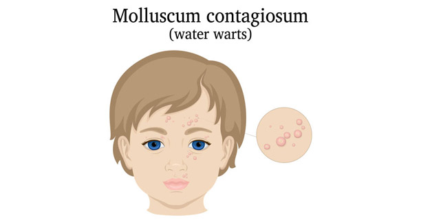 Diagnosis of Molluscum Contagiosum