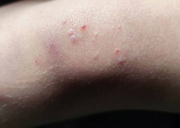 Overview of Molluscum Contagiosum