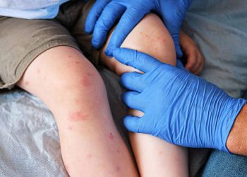 Prevention of Molluscum Contagiosum