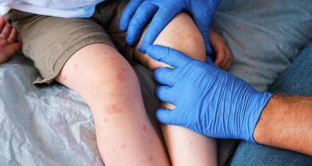 Prevention of Molluscum Contagiosum