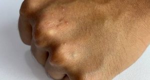 Symptoms of Molluscum Contagiosum