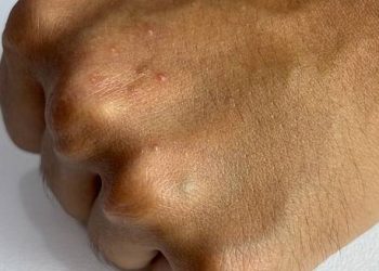 Symptoms of Molluscum Contagiosum