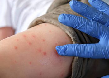 Treatment of Measles