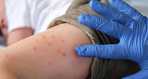 Treatment of Measles