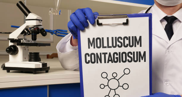 Treatment of Molluscum Contagiosum